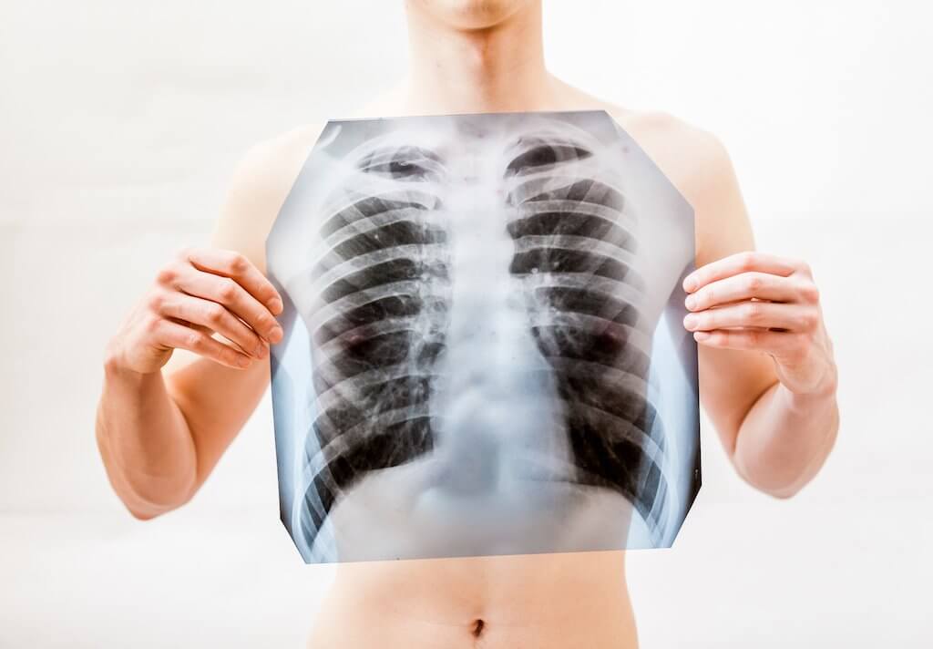 Penyakit paru obstruktif kronis