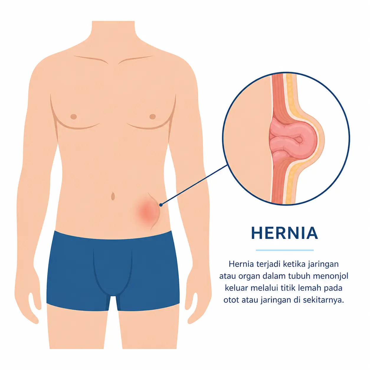 penyakit hernia